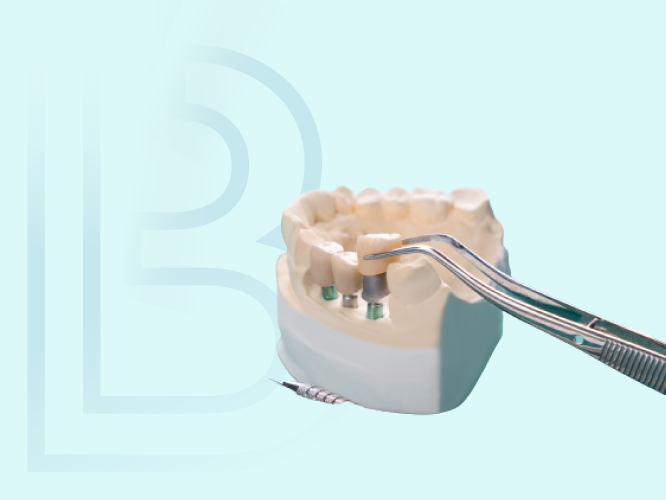 Implant - Retained Prostheses